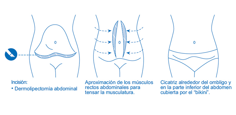Abdominoplastia o Cirugía del Abdomen - Articulos de Interés